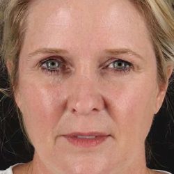 Neck Lift Before & After Patient #6720