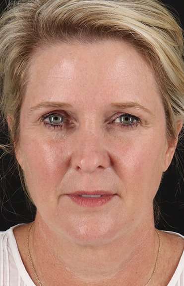 Neck Lift Before & After Patient #6720