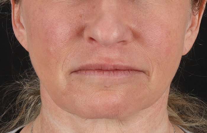 Neck Lift Before & After Patient #6731