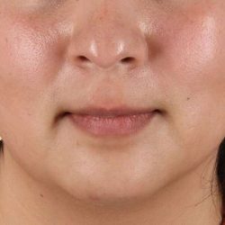 Neck Lift Before & After Patient #6743