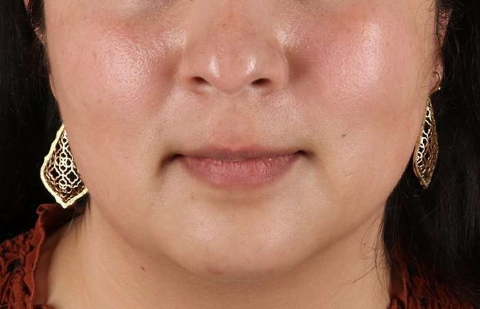 Neck Lift Before & After Patient #6743