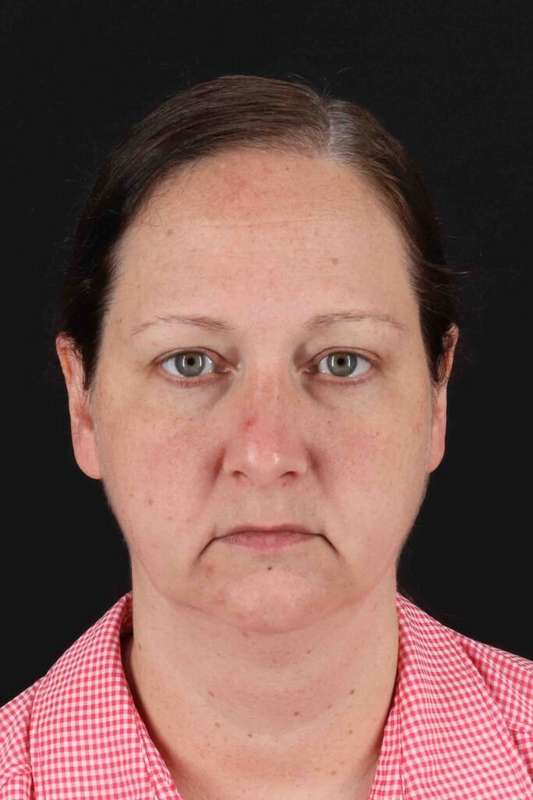 Neck Lift Before & After Patient #6756