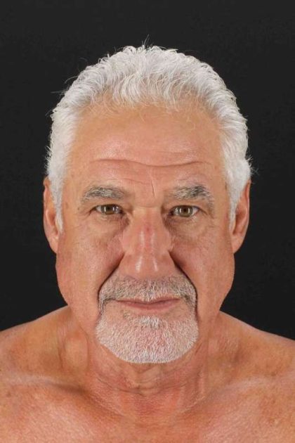 Neck Lift Before & After Patient #6788
