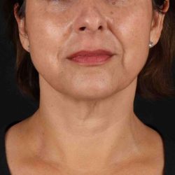 Neck Lift Before & After Patient #6797