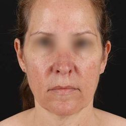 Neck Lift Before & After Patient #6838