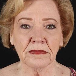 Neck Lift Before & After Patient #6845