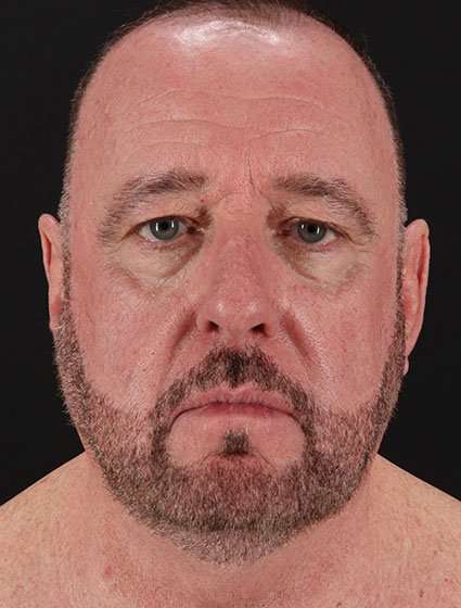 Neck Lift Before & After Patient #6856