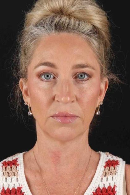 Neck Lift Before & After Patient #6867