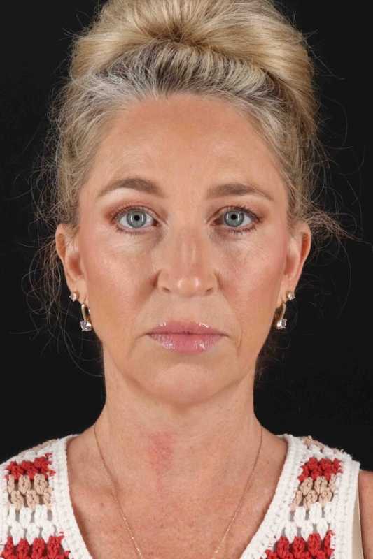 Neck Lift Before & After Patient #6867