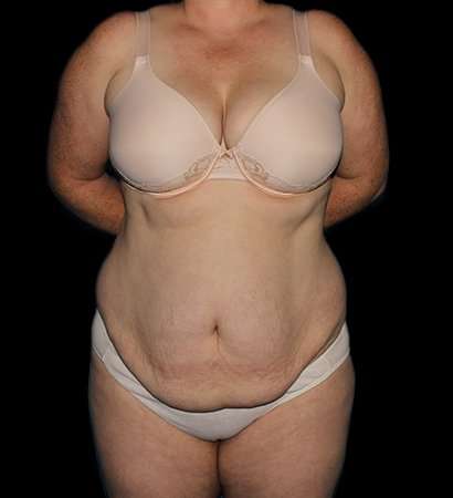 Abdominoplasty (Tummy Tuck) Before & After Patient #625