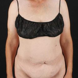 Cosmetic Body Lift Before & After Patient #1218