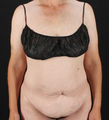 Cosmetic Body Lift Before & After Patient #1218