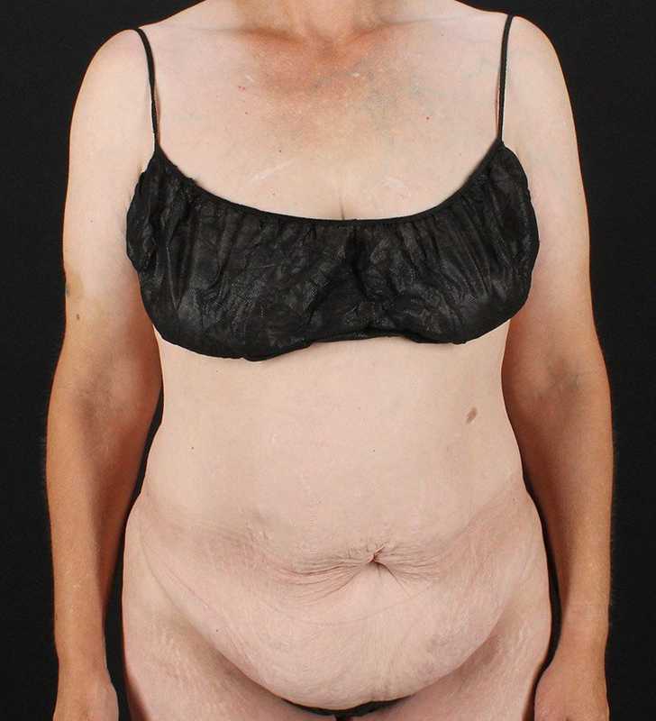 Cosmetic Body Lift Before & After Patient #1218