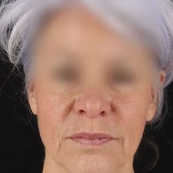 Neck Lift Before & After Patient #6878
