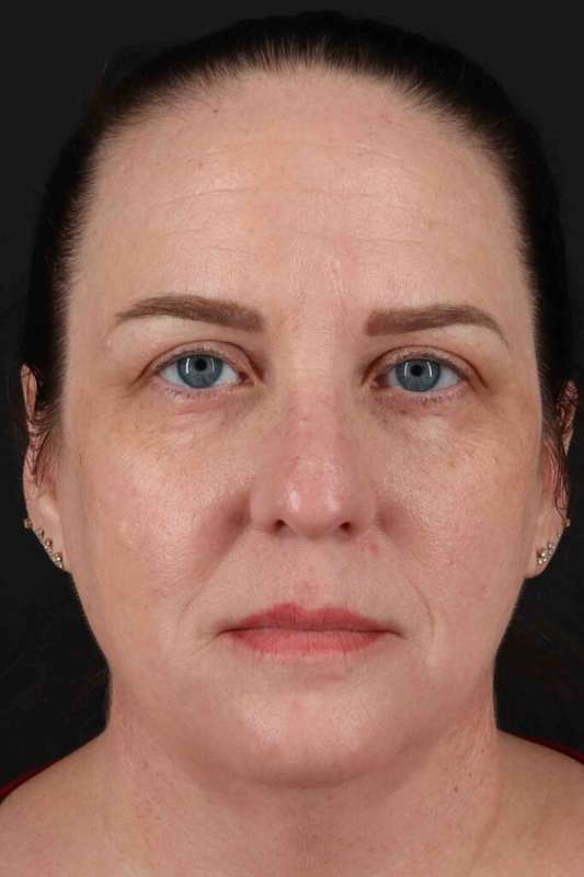 Neck Lift Before & After Patient #6898
