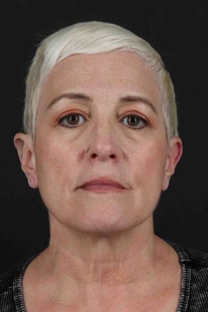 Neck Lift Before & After Patient #6909