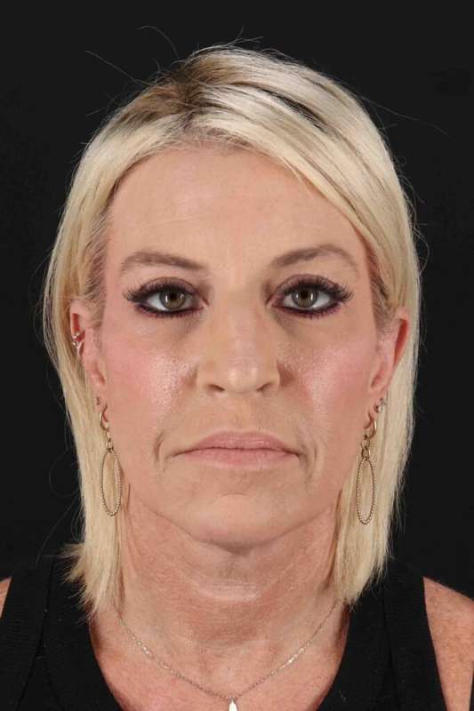 Neck Lift Before & After Patient #6920