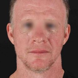 CO2 Laser Before & After Patient #6931