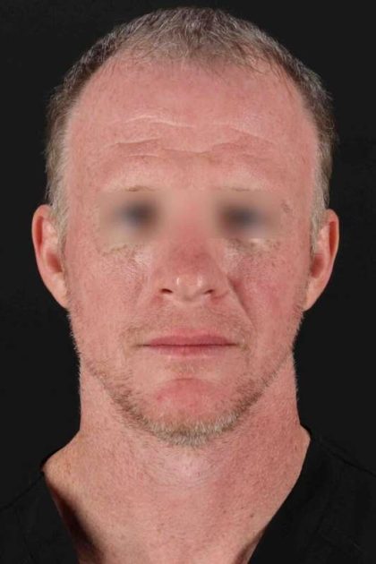 CO2 Laser Before & After Patient #6931