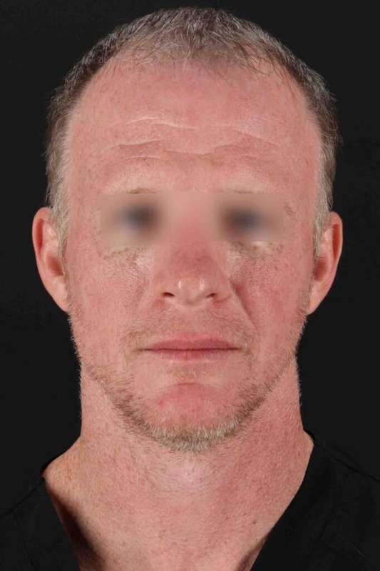 CO2 Laser Before & After Patient #6931