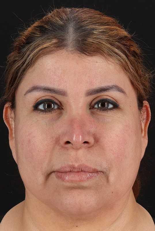 CO2 Laser Before & After Patient #6942