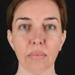 CO2 Laser Before & After Patient #6953