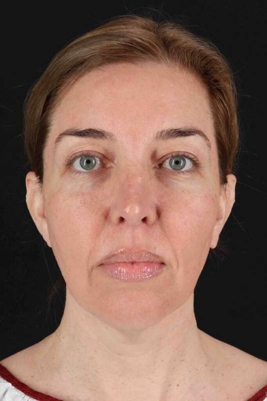 CO2 Laser Before & After Patient #6953