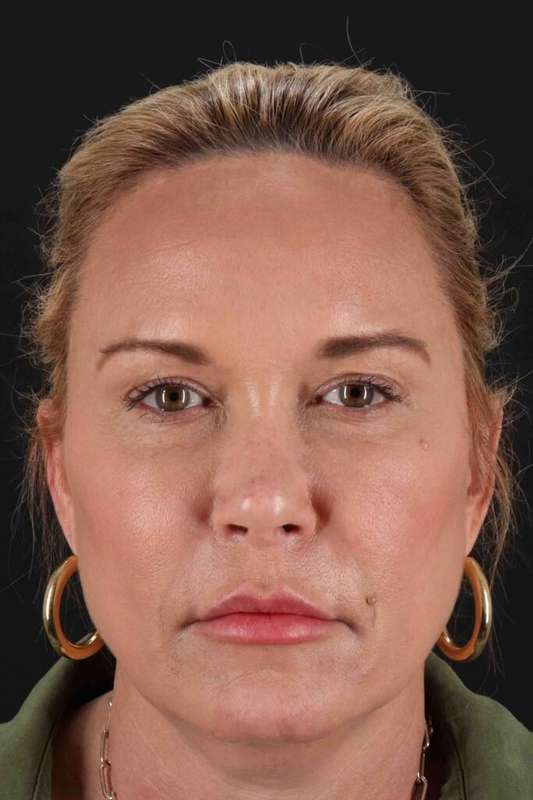 CO2 Laser Before & After Patient #6964