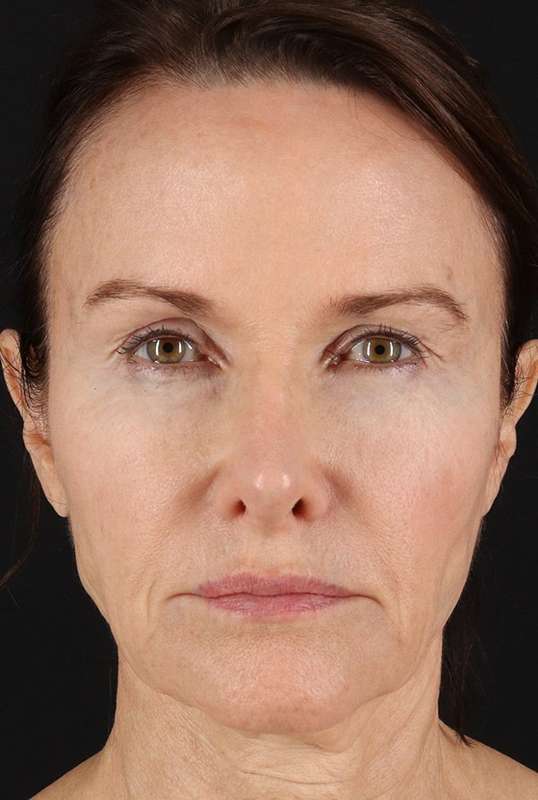CO2 Laser Before & After Patient #6975