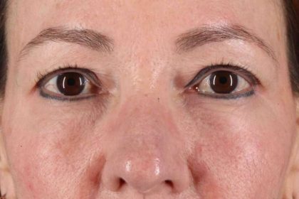 CO2 Laser Before & After Patient #6986