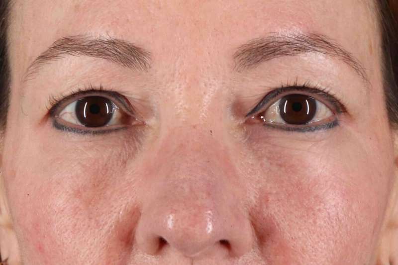CO2 Laser Before & After Patient #6986