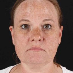 CO2 Laser Before & After Patient #6997