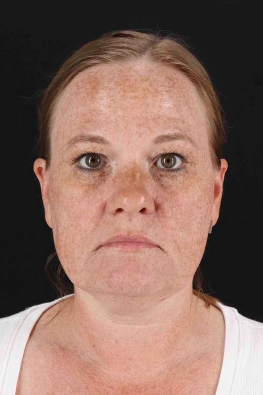 CO2 Laser Before & After Patient #6997