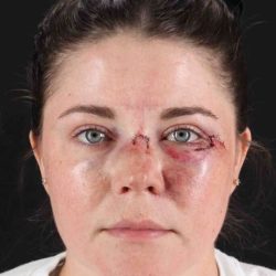 CO2 Laser Before & After Patient #7008