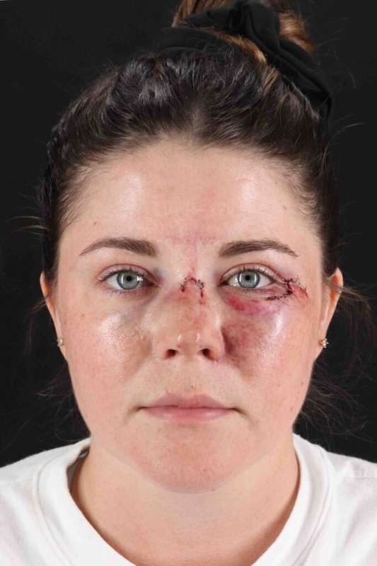 CO2 Laser Before & After Patient #7008