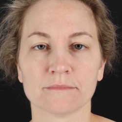 CO2 Laser Before & After Patient #7019