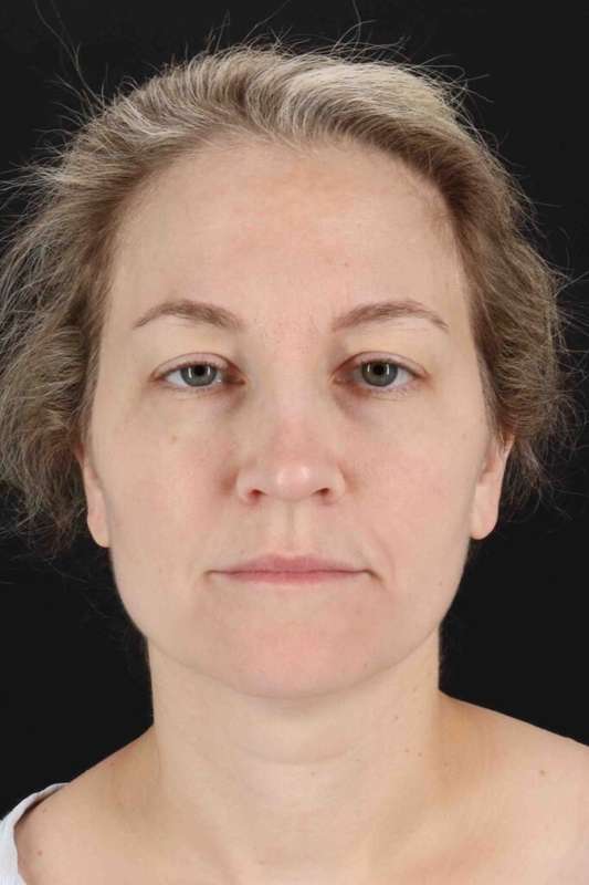 CO2 Laser Before & After Patient #7019