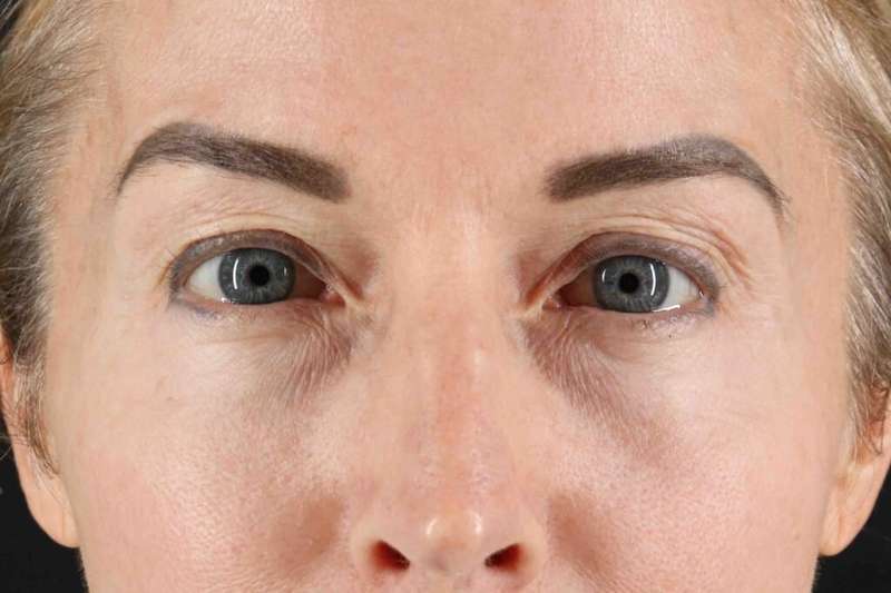 CO2 Laser Before & After Patient #7030
