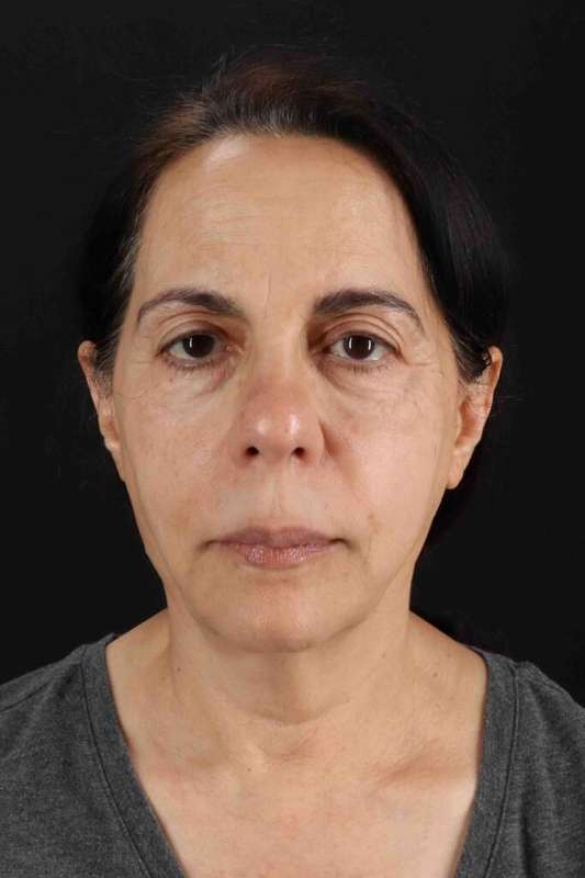 CO2 Laser Before & After Patient #7041