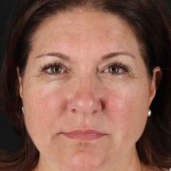 CO2 Laser Before & After Patient #7085