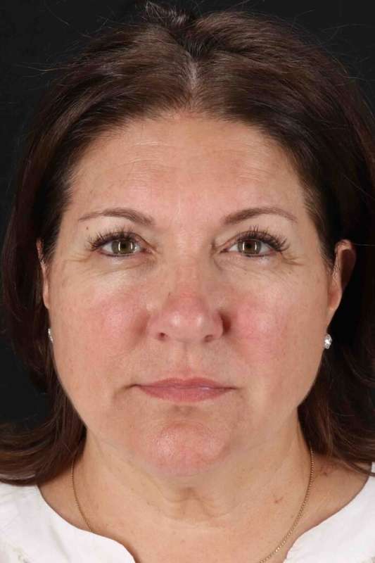 CO2 Laser Before & After Patient #7085