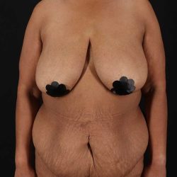 Cosmetic Body Lift Before & After Patient #1234