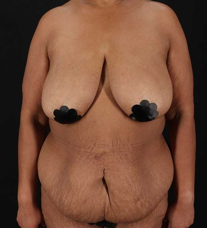 Cosmetic Body Lift Before & After Patient #1234