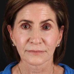 CO2 Laser Before & After Patient #7096