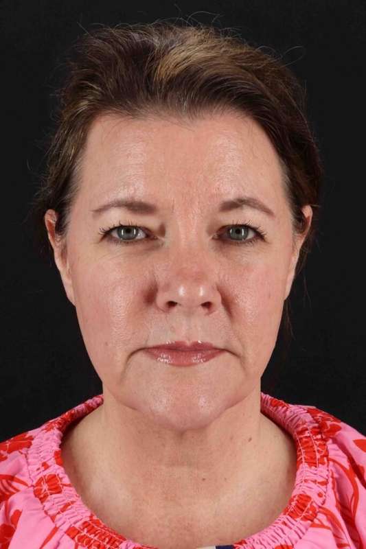 CO2 Laser Before & After Patient #7099