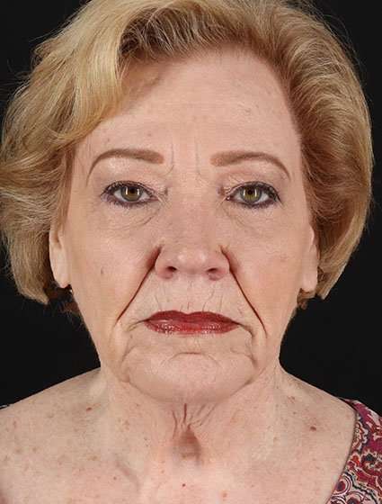 CO2 Laser Before & After Patient #7106