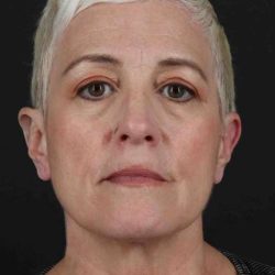 CO2 Laser Before & After Patient #7117