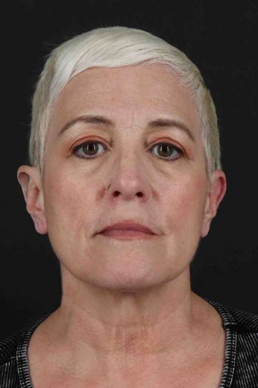 CO2 Laser Before & After Patient #7117