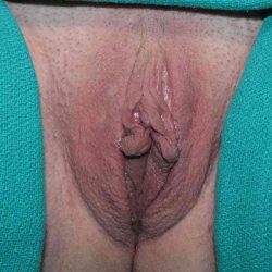 Labiaplasty Before & After Patient #1240