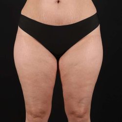 Liposuction Before & After Patient #1249